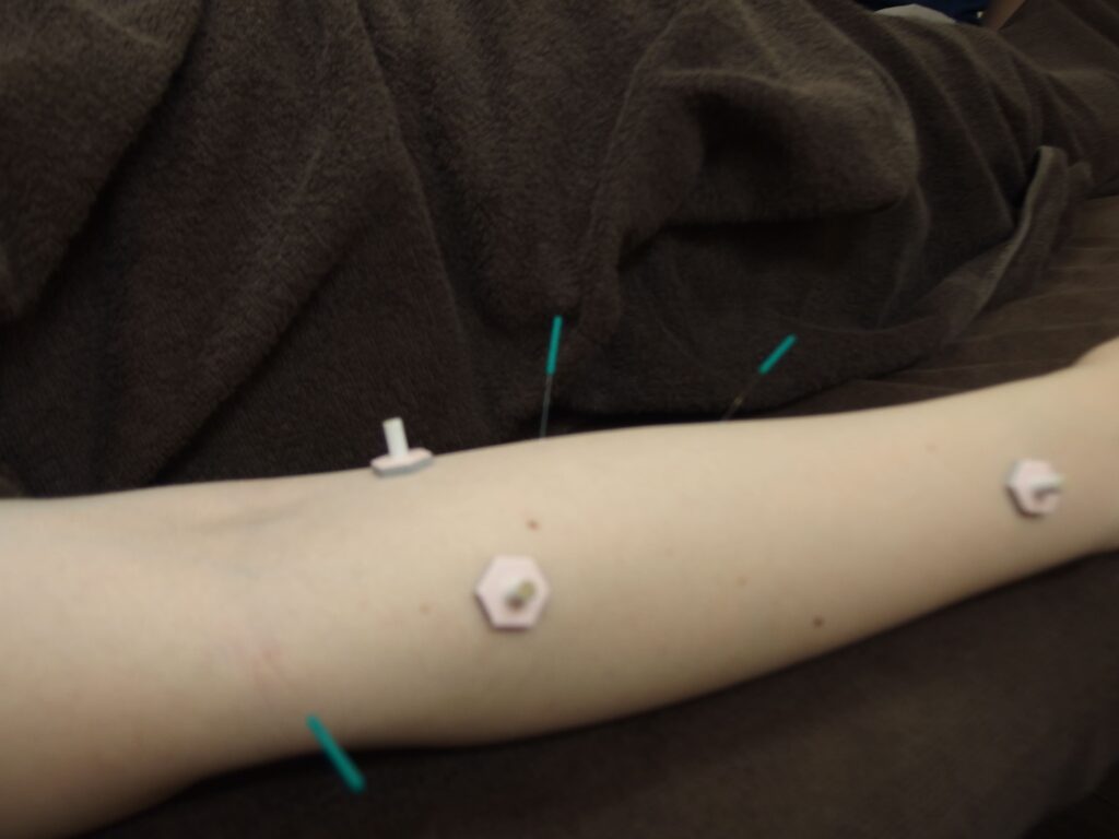 テニス肘の鍼灸治療